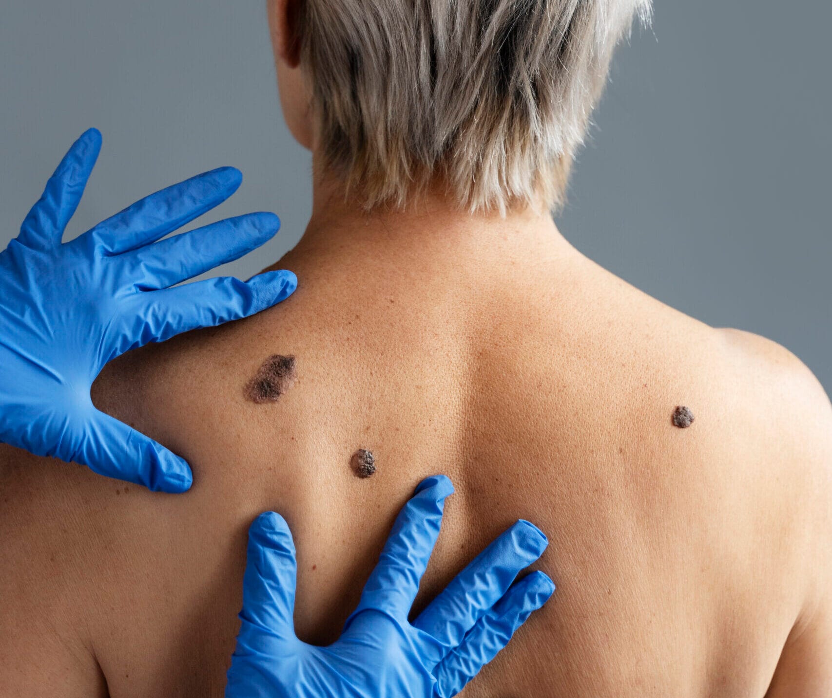 hands-with-gloves-touching-skin-with-melanoma